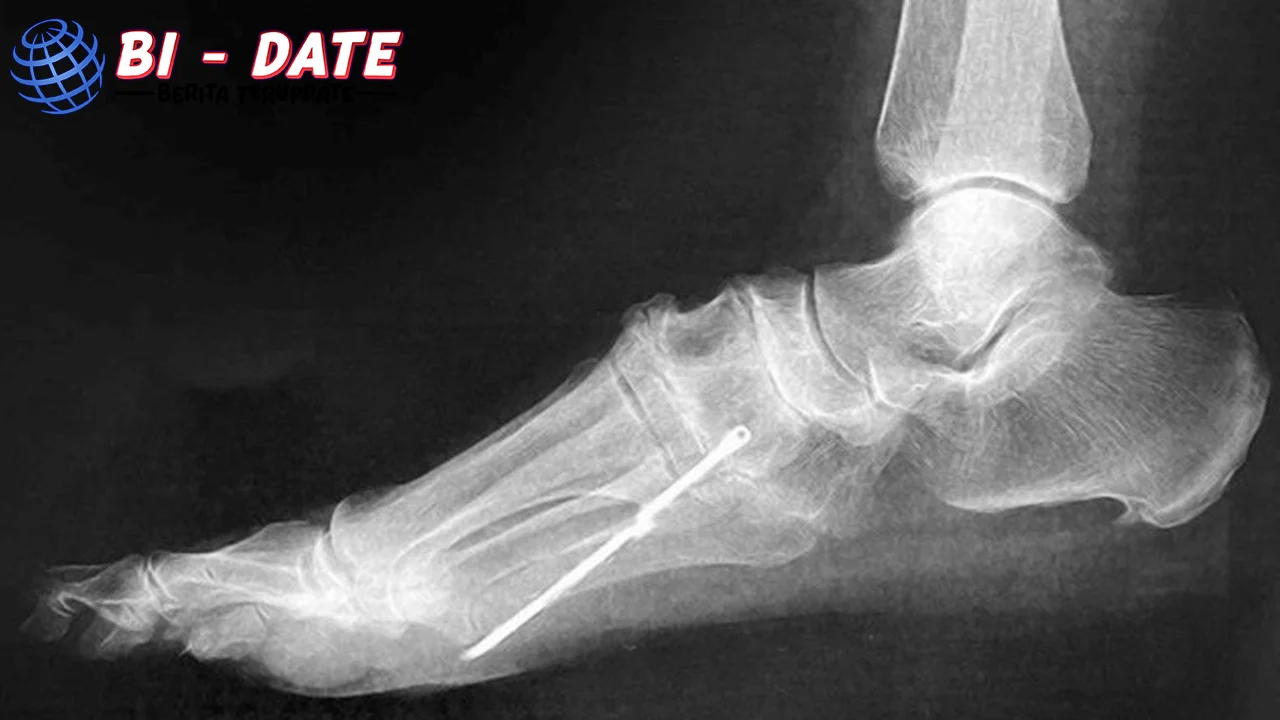 Misteri Rasa Sakit Kronis Terpecahkan: Ada 1 Besi di Kaki!