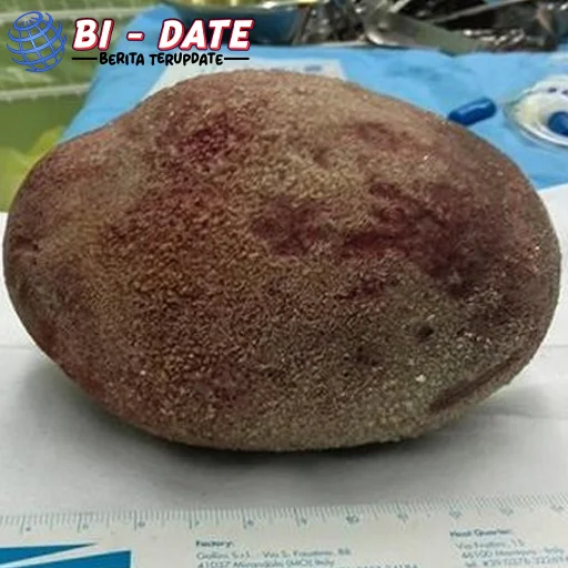 Batu Kandung Kemih Tepat Seberat 1 Kg Bisa Terjadi?