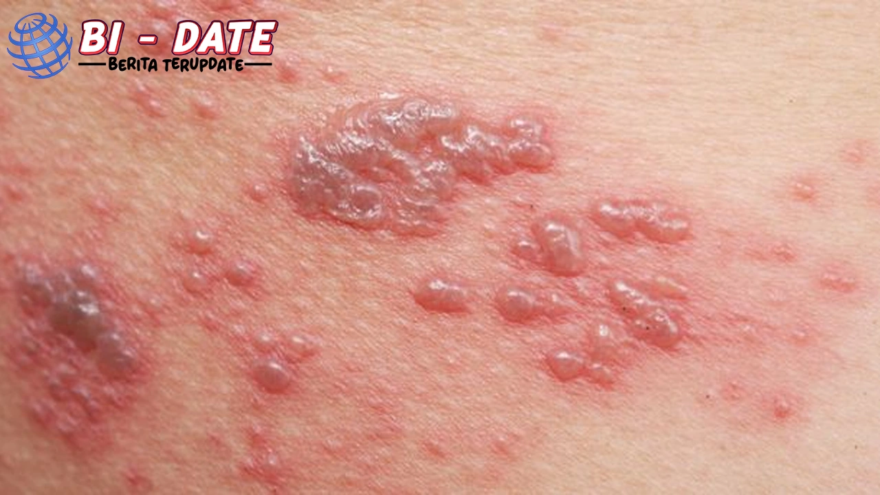 Cacar Air Kambuh? Jangan Panik! Ini 3 Solusinya!