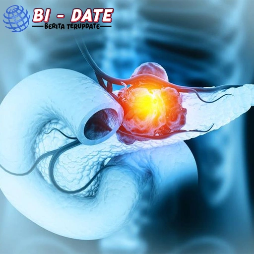 Kisah Pria Idap 1 Kanker Pankreas, Dikira Sakit Punggung Baru