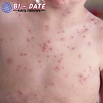 Cacar Air Kambuh? Jangan Panik! Ini 3 Solusinya!