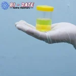 Jangan Abaikan! Urine Berubah? Bisa Jadi 1 Masalah Ginjal