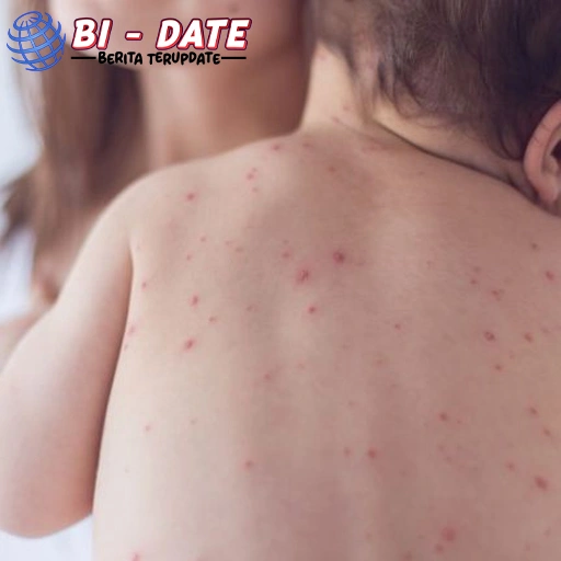 Kasus Campak Naik Lagi, Ini 5 Tips Biar Anak Aman