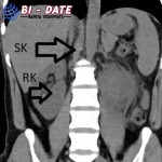 Pria ini Punya 3 Ginjal, Langka Banget
