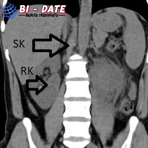 Pria ini Punya 3 Ginjal, Langka Banget