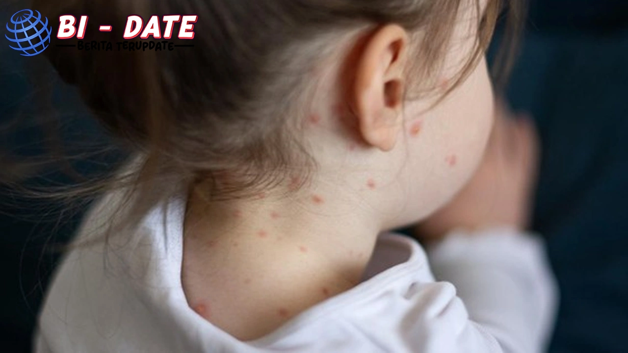 IDAI Campak Penuh Risiko! Anti-Vaksin 2x Gawat Darurat!