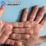 Waspada KLB Campak, Ada baru 45 Kasus di RI Bos!