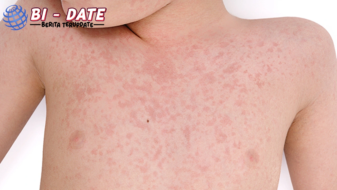 Campak Saran 8 Kemenkes Selain Imunisasi!